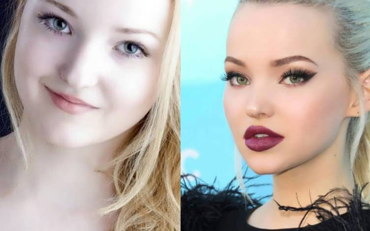 Full Details on Dove Cameron Plastic Surgery